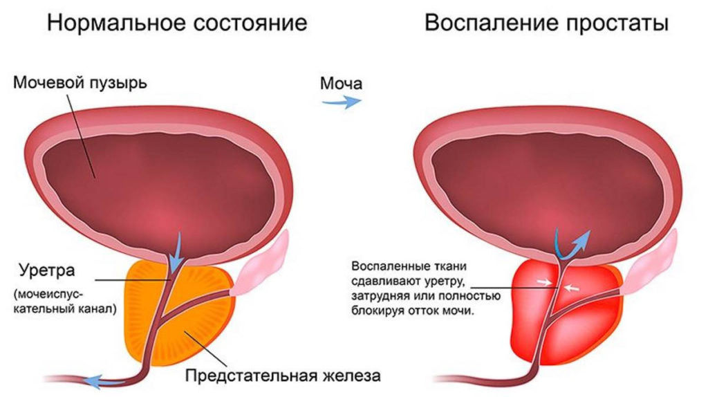 зуд и жжение при мочеиспускании у мужчин