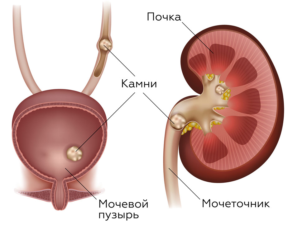 лечение при мочекаменной болезни у мужчин