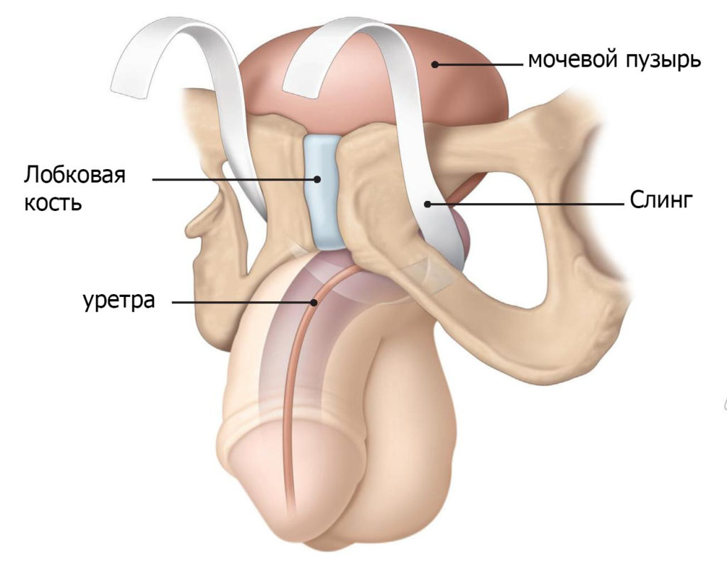 как лечить недержание мочи у мужчин